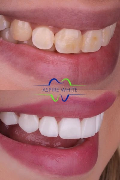 Before and after laser whitening results Swindon