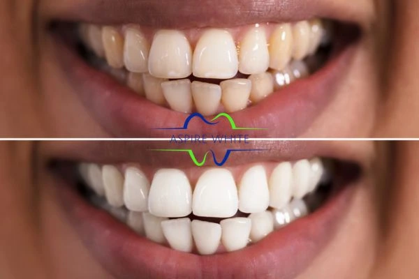 Aspire White customer before and after Swindon results.