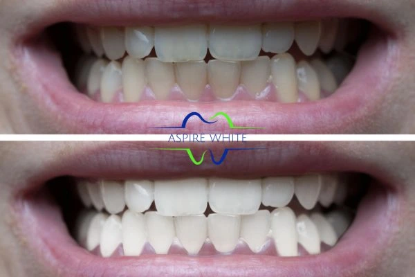 1 hour laser teeth whitening before and after results Swindon