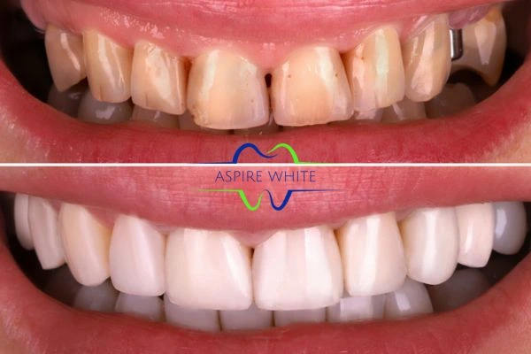 Yellow teeth results - 1 hour whitening before and after results Swindon