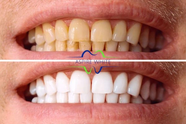 Get noticeable whiter smile in just one hour! Book your teeth whitening treatment Swindon today!
