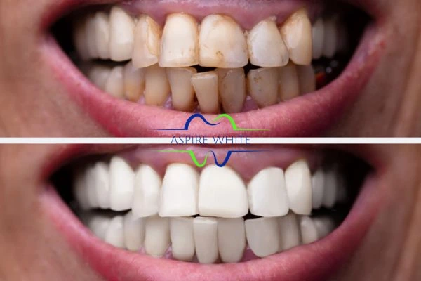 Before and after results of laser teeth whitening Swindon Book in online today!