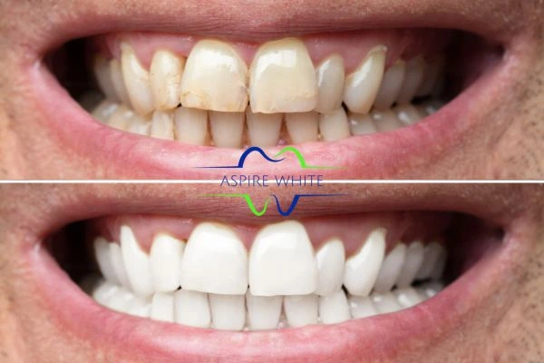 Achieve a radiant smile with professional laser teeth whitening Swindon